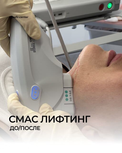 SMAS-лифтинг: фото до и после фото 1
