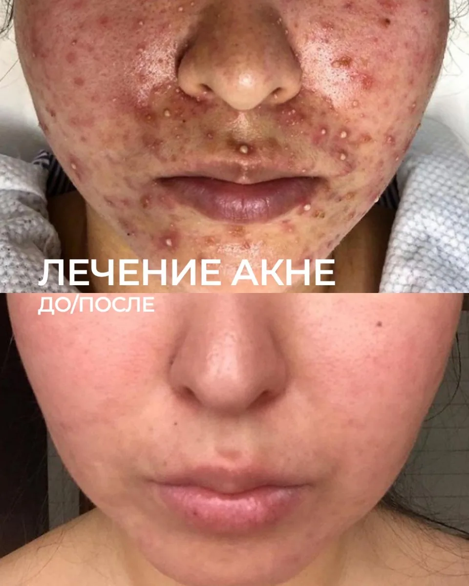 Лечение акне: фото результата 1